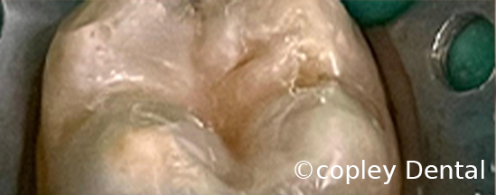 CASE 10: Cosmetic Dentistry – White Dental Filling - After