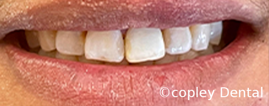 CASE 47: Fractured Tooth - After