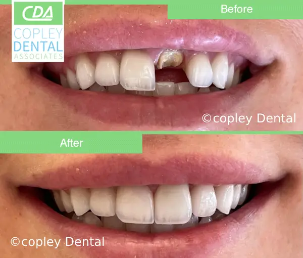 CASE 49: Fractured Tooth