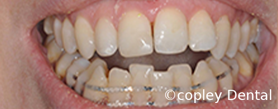 CASE 50: Fractured Tooth - Reimplantation - After