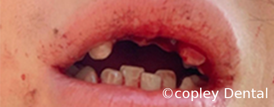 CASE 50: Fractured Tooth - Reimplantation - Before