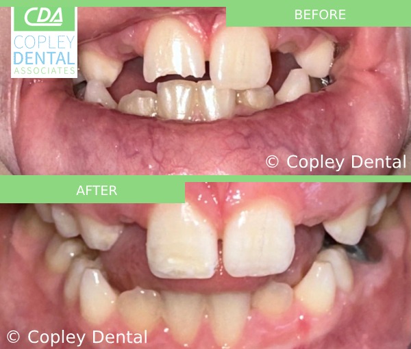 CASE 53: Fractured Tooth