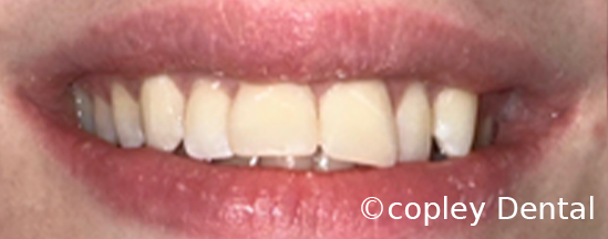 CASE 57: Fractured Tooth - After