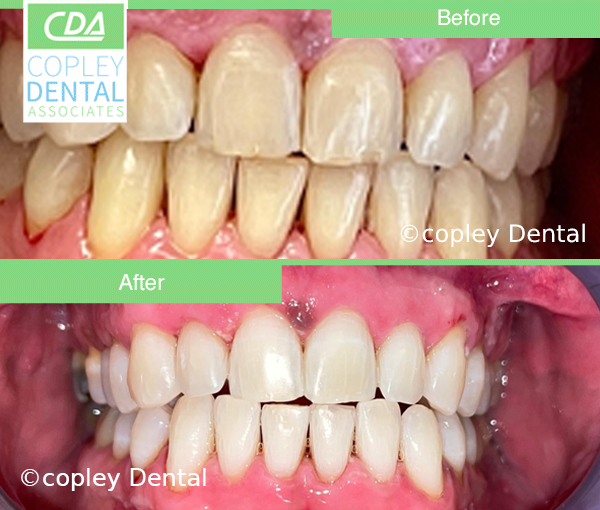 CASE 60: Cosmetic Dentistry – Teeth Whitening