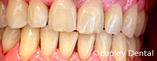 CASE 60: Cosmetic Dentistry – Teeth Whitening - Before