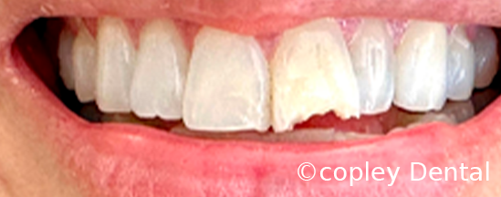 CASE 62: Fractured Tooth - Before