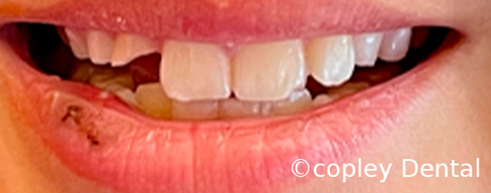 CASE 63: Fractured Tooth - Before