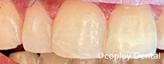 CASE 64: Fractured Tooth - After