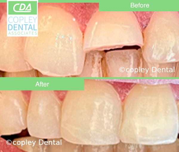 CASE 64: Fractured Tooth