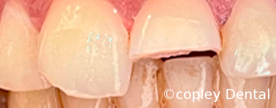 CASE 64: Fractured Tooth - Before