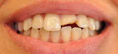 CASE 42: Emergency Dentist – Broken Tooth - Before