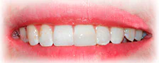 CASE 1: Emergency Treatment – Fractured Tooth - After
