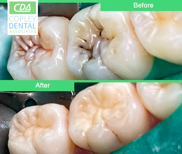 CASE 43: Tooth-Colored Dental Fillings
