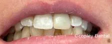 CASE 44: Fractured Tooth - After