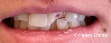 CASE 44: Fractured Tooth - Before