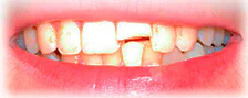 CASE 1: Emergency Treatment – Fractured Tooth - Before
