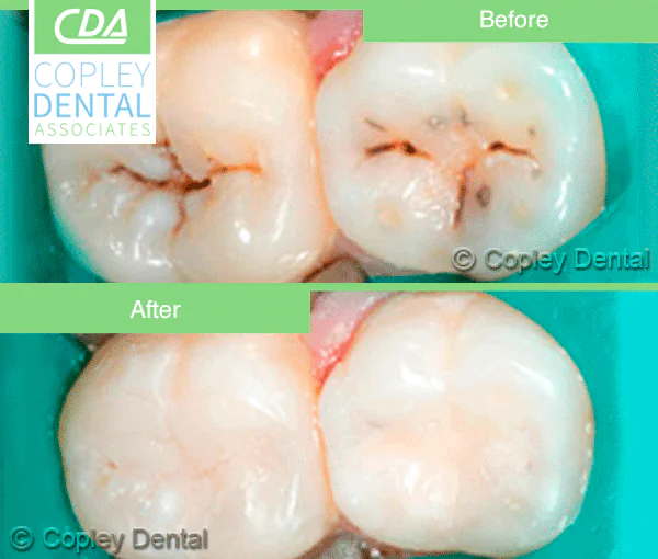 CASE 10: Cosmetic Dentistry – White Dental Filling
