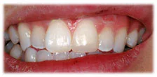 CASE 11: Emergency Dentist – Chipped Tooth - After