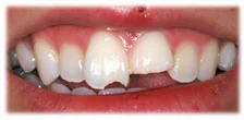 CASE 11: Emergency Dentist – Chipped Tooth - Before
