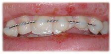 CASE 14: Dental Trauma- Broken Teeth - Before