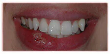CASE 15: Emergency Dentist – Fractured Tooth - After