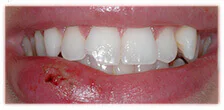 CASE 15: Emergency Dentist – Fractured Tooth - Before