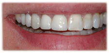 CASE 16: Broken Fractured Tooth - After