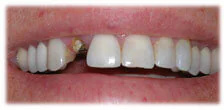 CASE 16: Broken Fractured Tooth - Before