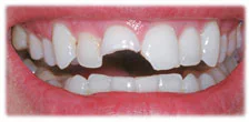CASE 17: Emergency Treatment – Broken Teeth - Before