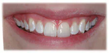 CASE 18: Broken Fractured Tooth - After