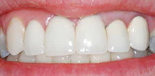 CASE 19: Emergency Treatment – Fractured Tooth - After