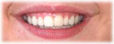 CASE 2: Cosmetic Dentistry – Lumineers - After