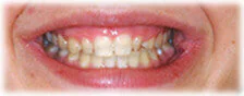 CASE 2: Cosmetic Dentistry – Lumineers - Before