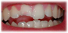 CASE 20: Broken Fractured Tooth - Before
