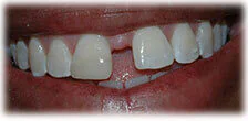 CASE 21: Emergency Dentist – Fractured Tooth - After