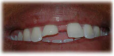 CASE 21: Emergency Dentist – Fractured Tooth - Before