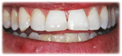 CASE 23: Emergency Treatment – Fractured Tooth - After