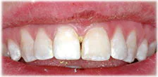 CASE 24: Broken Fractured Tooth - After