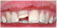 CASE 24: Broken Fractured Tooth - Before