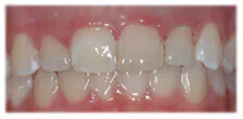 CASE 25: Emergency Treatment – Fractured Tooth - After