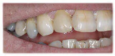 CASE 26: Broken Fractured Tooth - After