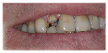 CASE 26: Broken Fractured Tooth - Before