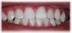 CASE 27: Emergency Treatment – Fractured Tooth - After