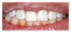 CASE 28: Broken Fractured Tooth - After