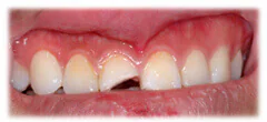 CASE 28: Broken Fractured Tooth - Before