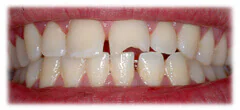 CASE 29: Emergency Treatment – Broken Teeth - Before
