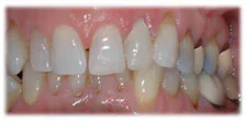 CASE 3: Emergency Dentist Fractured Broken Tooth - After