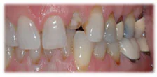 CASE 3: Emergency Dentist Fractured Broken Tooth - Before