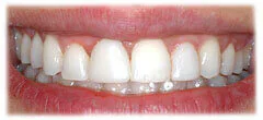 CASE 30: Cosmetic Lengthening - After