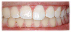 CASE 32: Broken Fractured Tooth - After